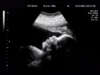 Emergency Management Of Placental Abruption